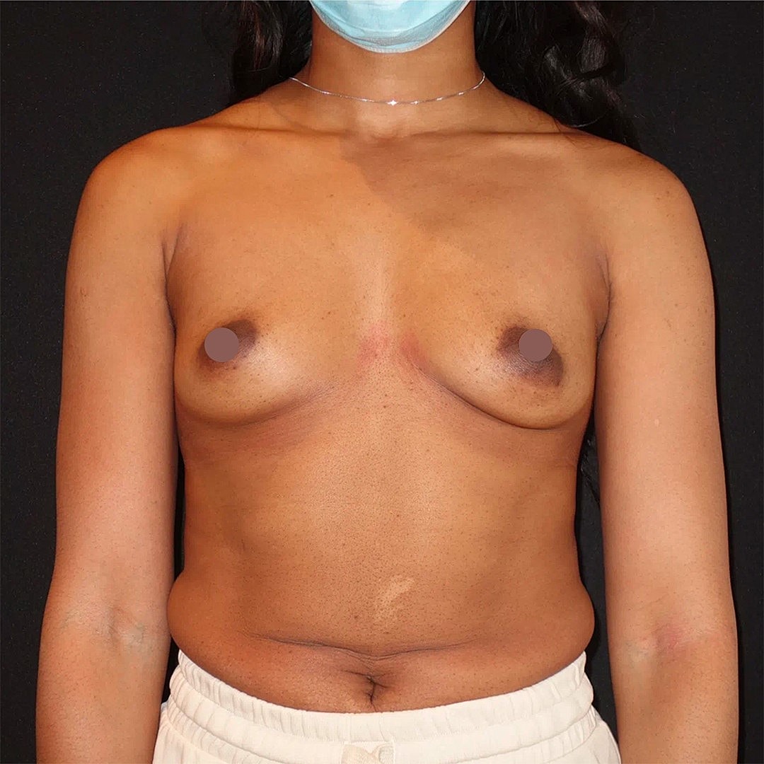 Breast Augmentation Before & After