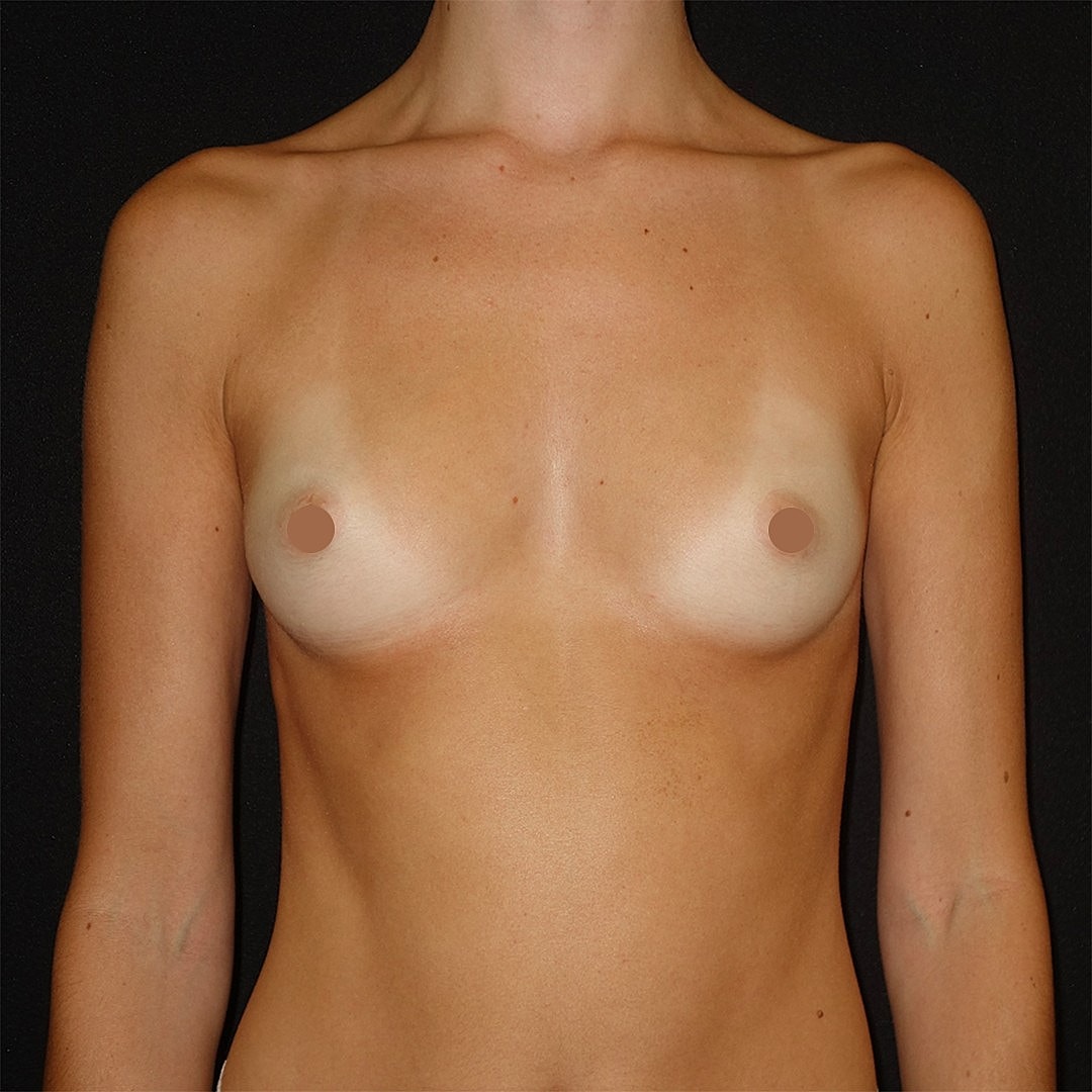Breast Augmentation Before & After