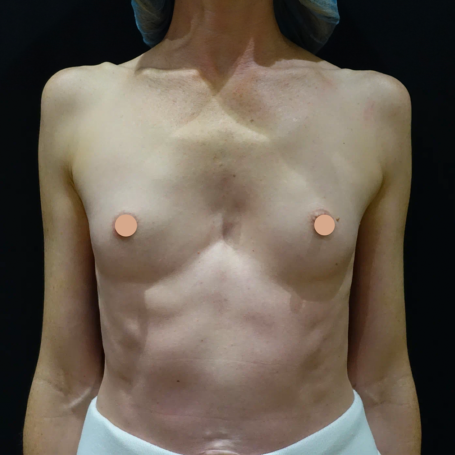 Breast Augmentation Before & After