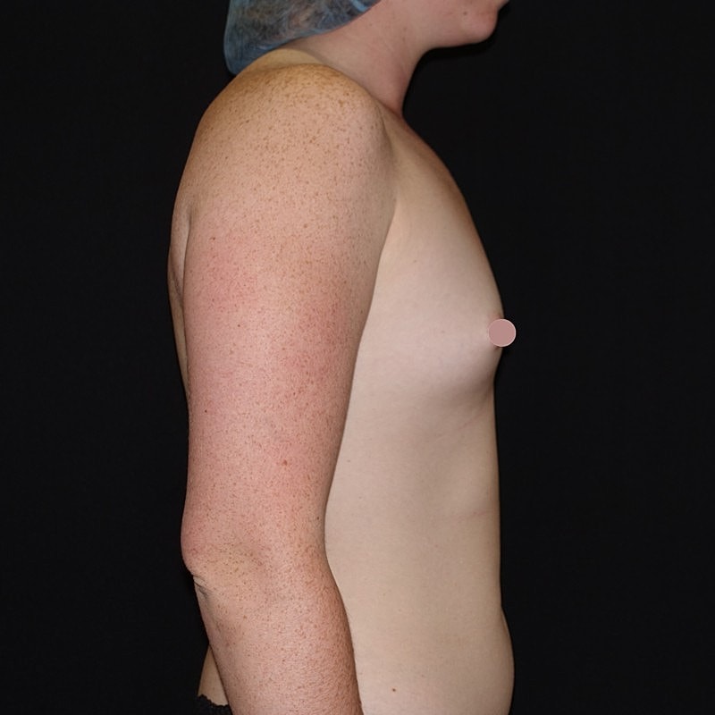 Breast Augmentation Before & After