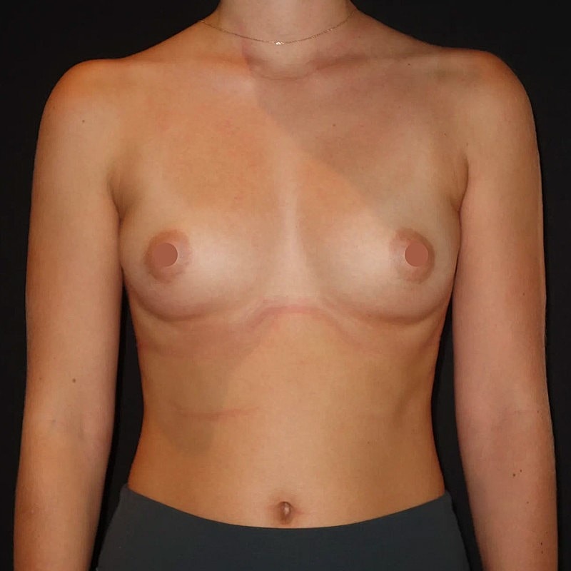 Breast Augmentation Before & After